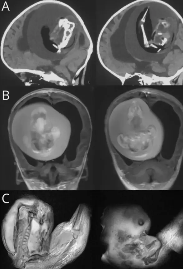 Doctors Shocked To Find Fetus Growing In One-Year-Old’s Skull