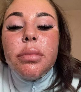 Influencer’s Face Was Horribly Burned While Attempting ‘Dangerous’ Tanning Bed Hack