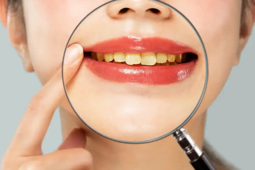 Dentist Explains Why Your Teeth Are Yellow Despite Always Brushing Them